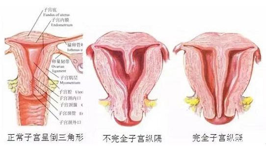 縱隔子宮