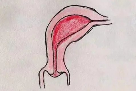 單角子宮能正常生育嗎？單角子宮對懷孕的影響