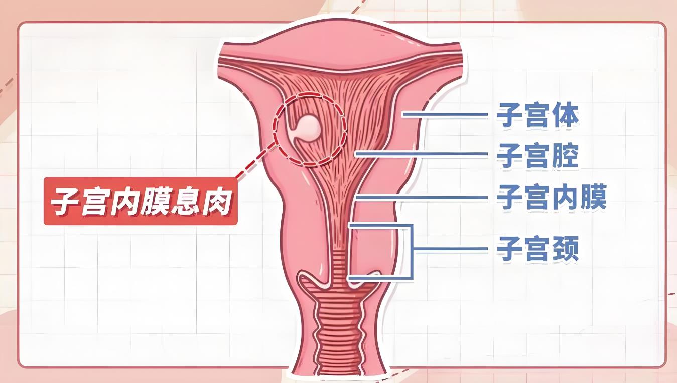 子宮內(nèi)膜息肉